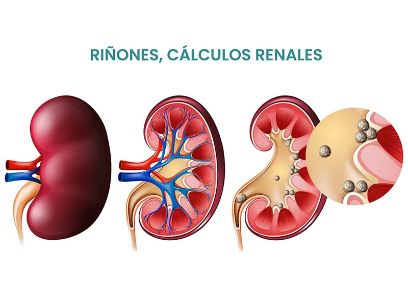 Tratamiento cálculos renales Quito Dr Sebastian Hervas Urólogo Quito-min
