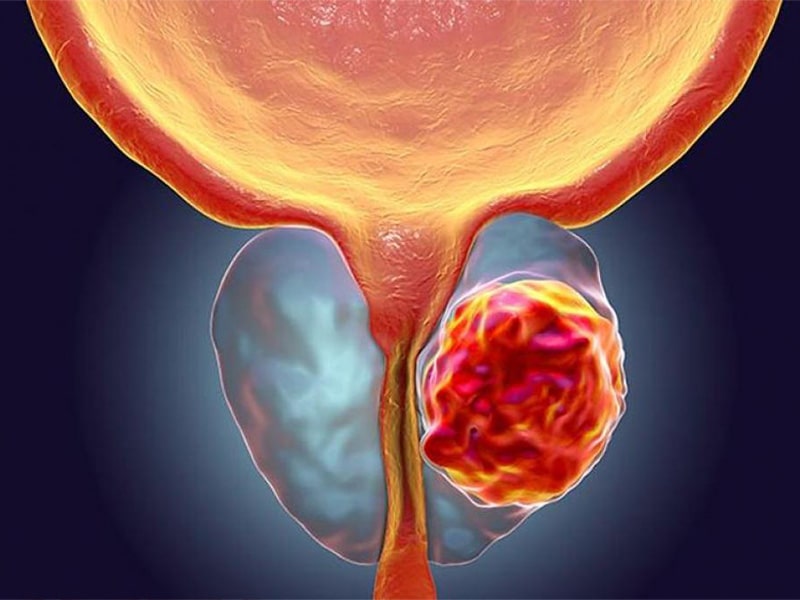 Cirugía de prostata Quito Cáncer de Prostata Tratamiento Dr Sebatian Hervas-min
